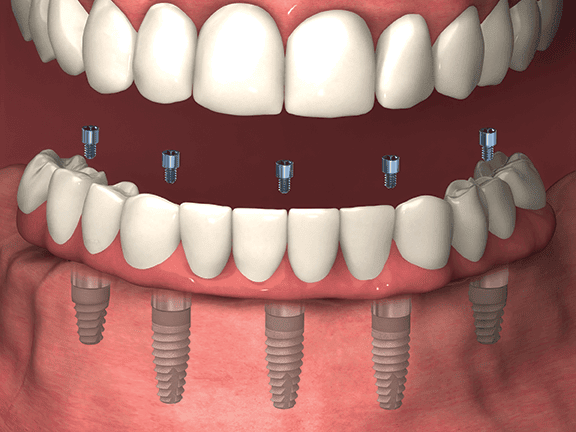 Whitlow Dental Care - Dental Implant Center photo 5