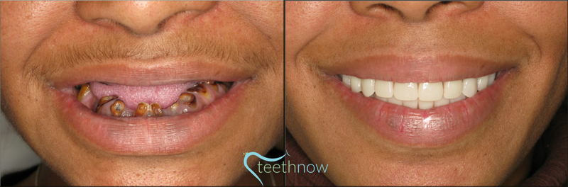 Teethnow Dental Implants New York City photo 6