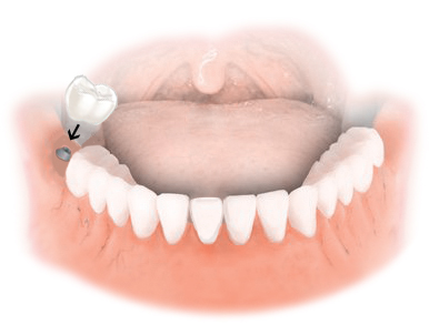 Dental Implant Solutions of Martinsville Va photo 2