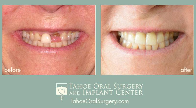 Tahoe Oral Surgery And Implant Center photo 4