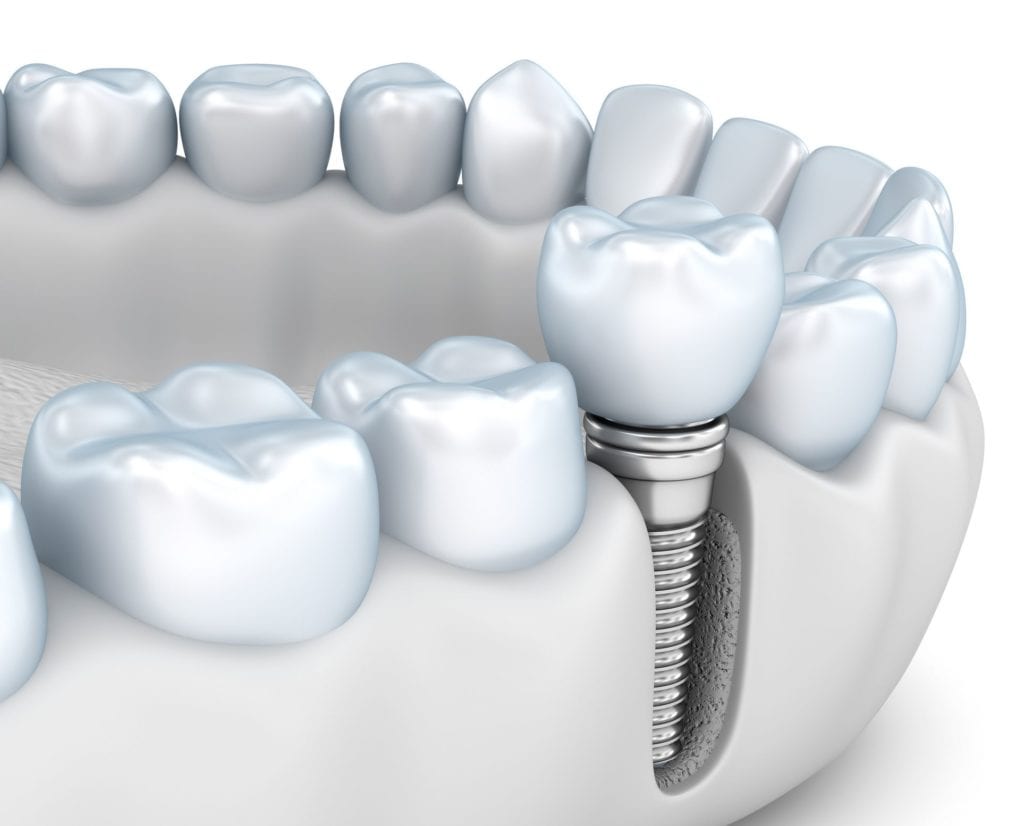Implant Dentistry of Florida photo 6