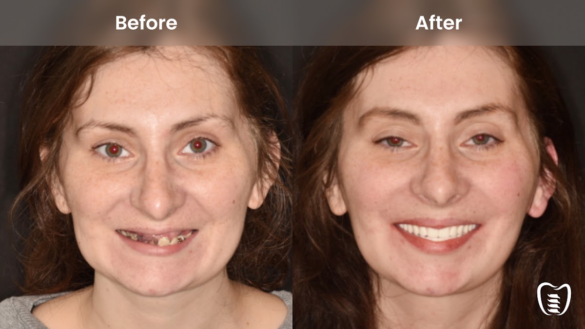 All on Implants Charleston photo 6
