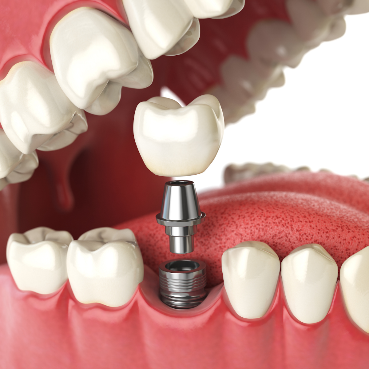 Dental, Dentures & Implants - Dr. Nathan Faber photo 2