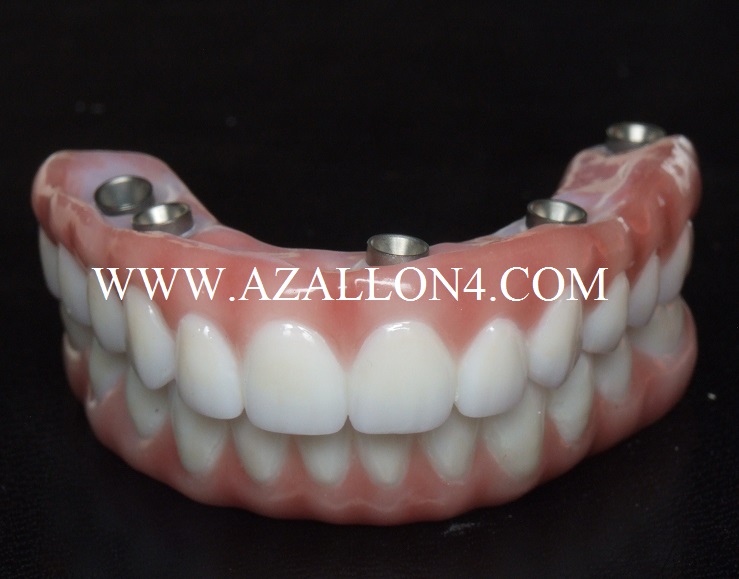 Az All on 4 Implants photo 3