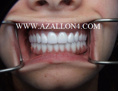 Az All on 4 Implants photo 5