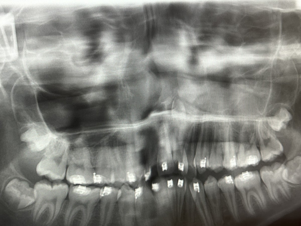 Omssc, Wisdom Teeth Removal & Sedation, Dr. Ali Board-Certified Oral Surgeon photo 4
