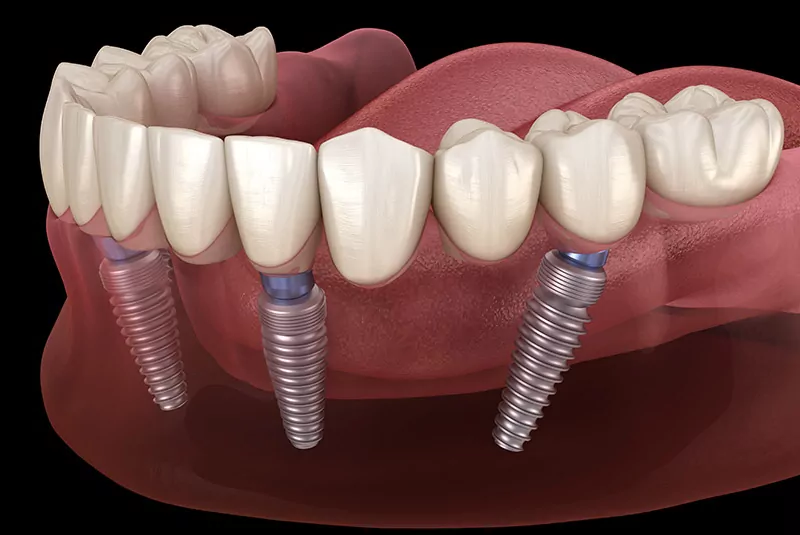 Dental Implants Phoenix photo 1