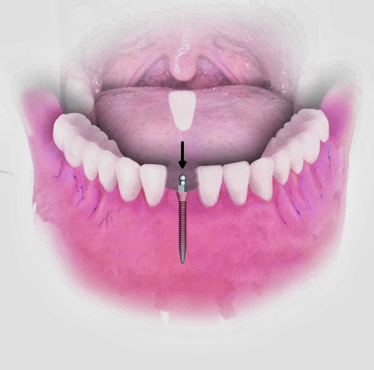 Dental Implant Solutions of the Villages Fl photo 1