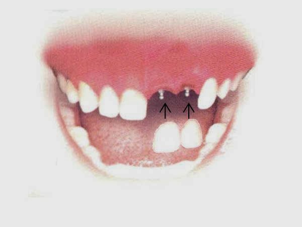 Dental Implant Solutions of the Villages Fl photo 2