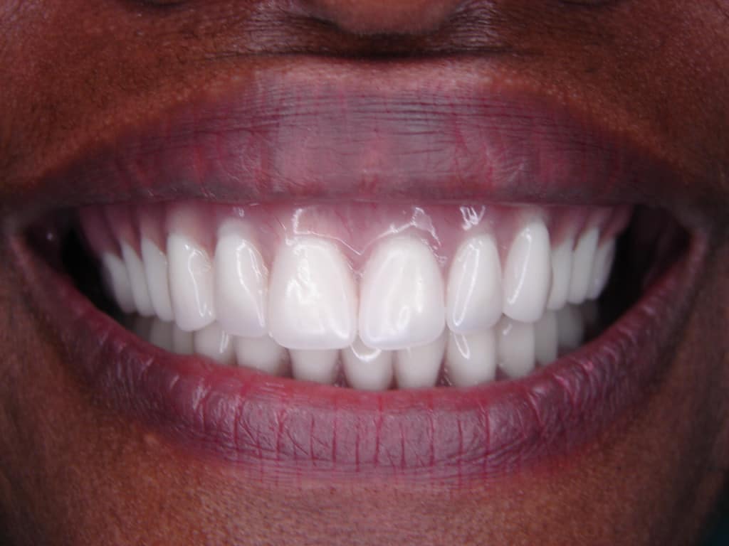 All Smiles Family Dentistry - Dentures, Extractions, Dental Implants, Quick Dentures photo 6