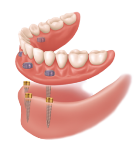 Artistic Denture photo 1