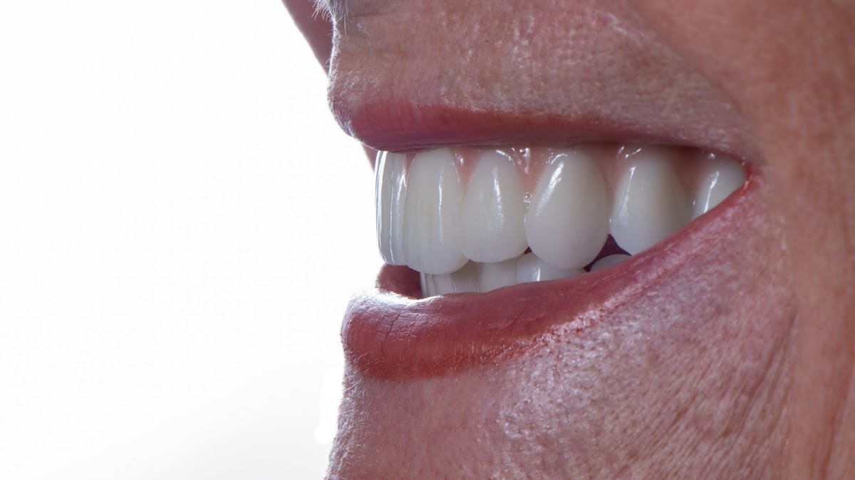 Next Smile + Implant photo 1