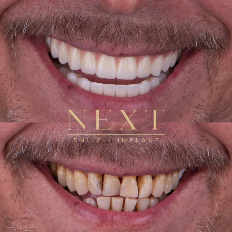 Next Smile + Implant photo 3