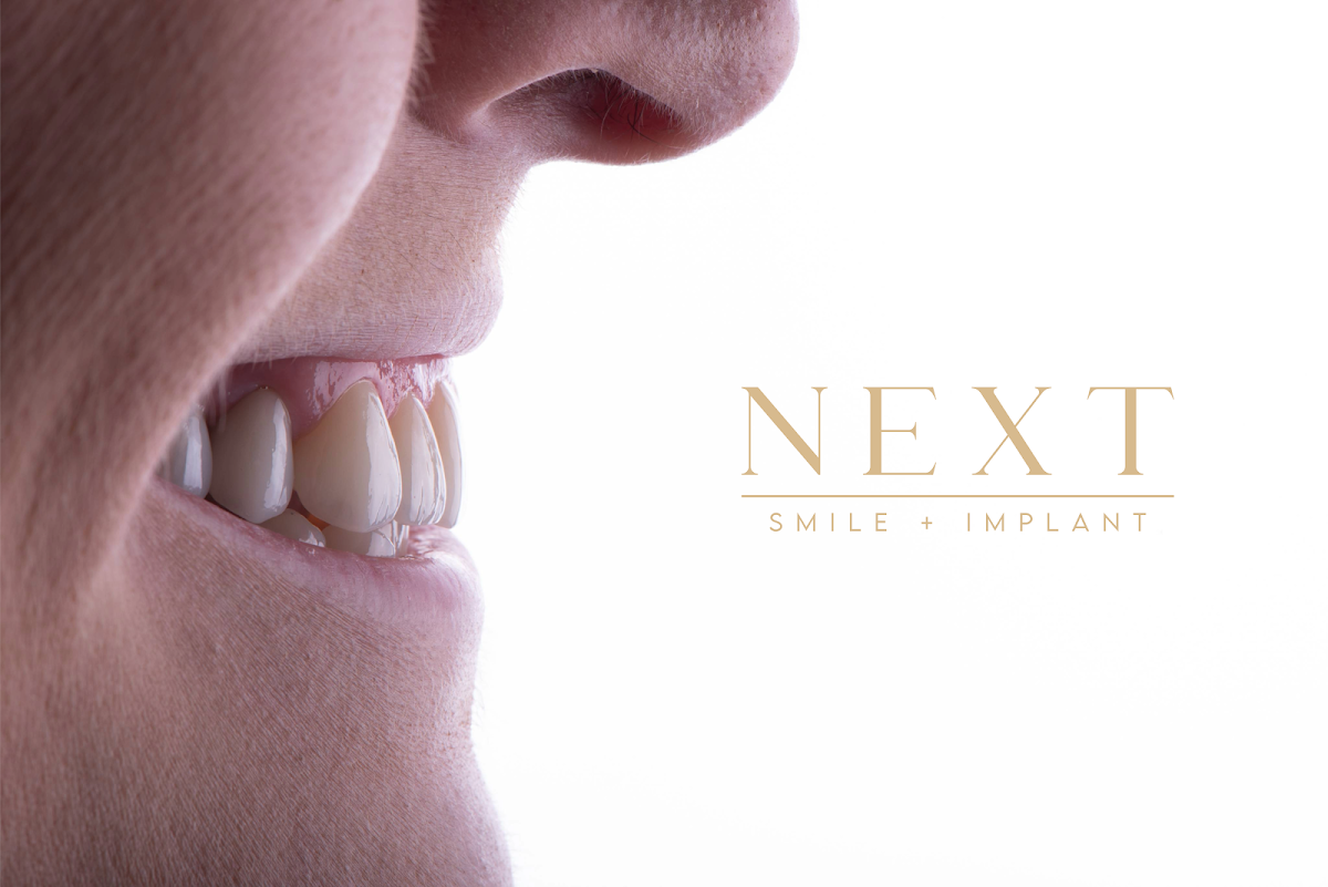 Next Smile + Implant photo 5