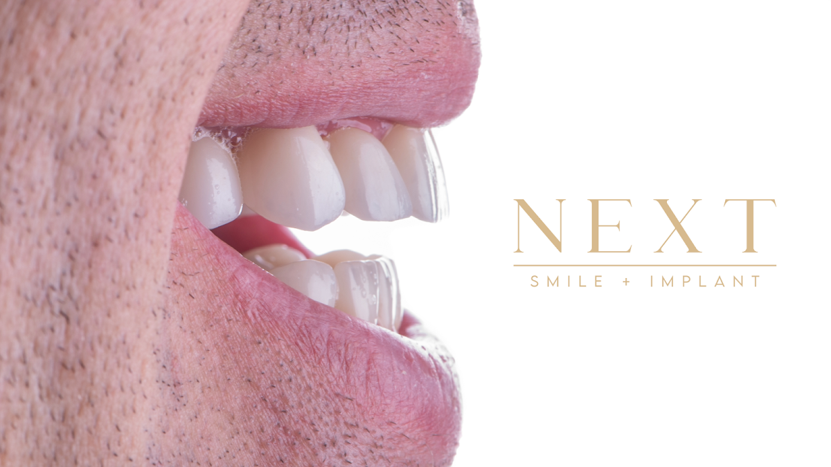 Next Smile + Implant photo 6