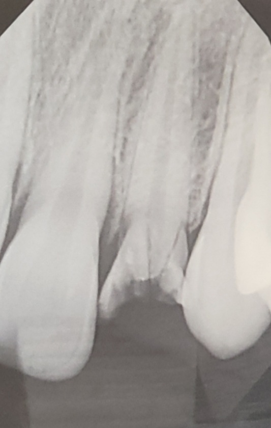 Bright Now! Dental & Implants - Spokane Valley, Wa photo 6