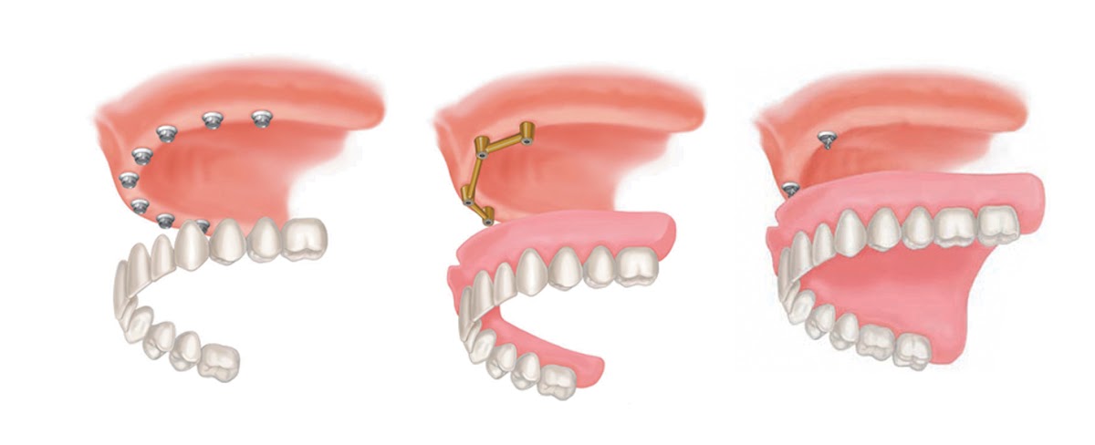 Natural Fit Dentures & Denture Care Ogden-layton photo 1