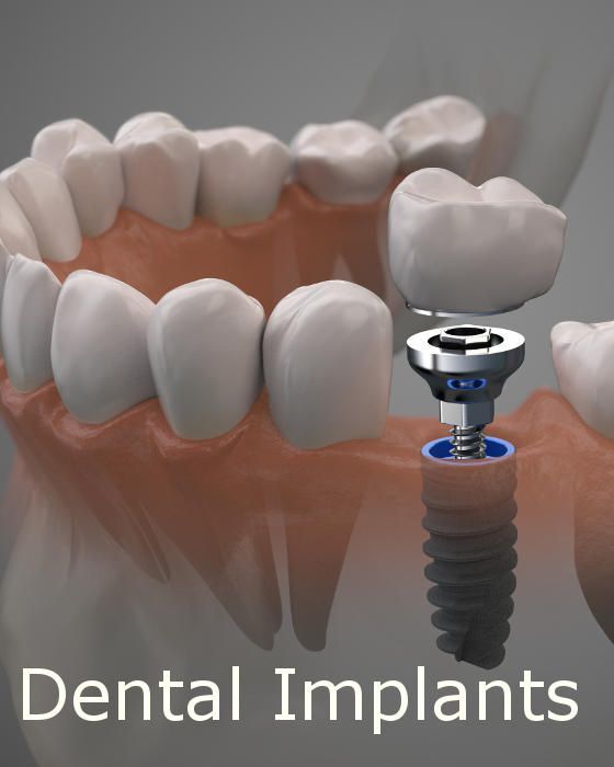 Natural Fit Dentures & Denture Care Ogden-layton photo 2