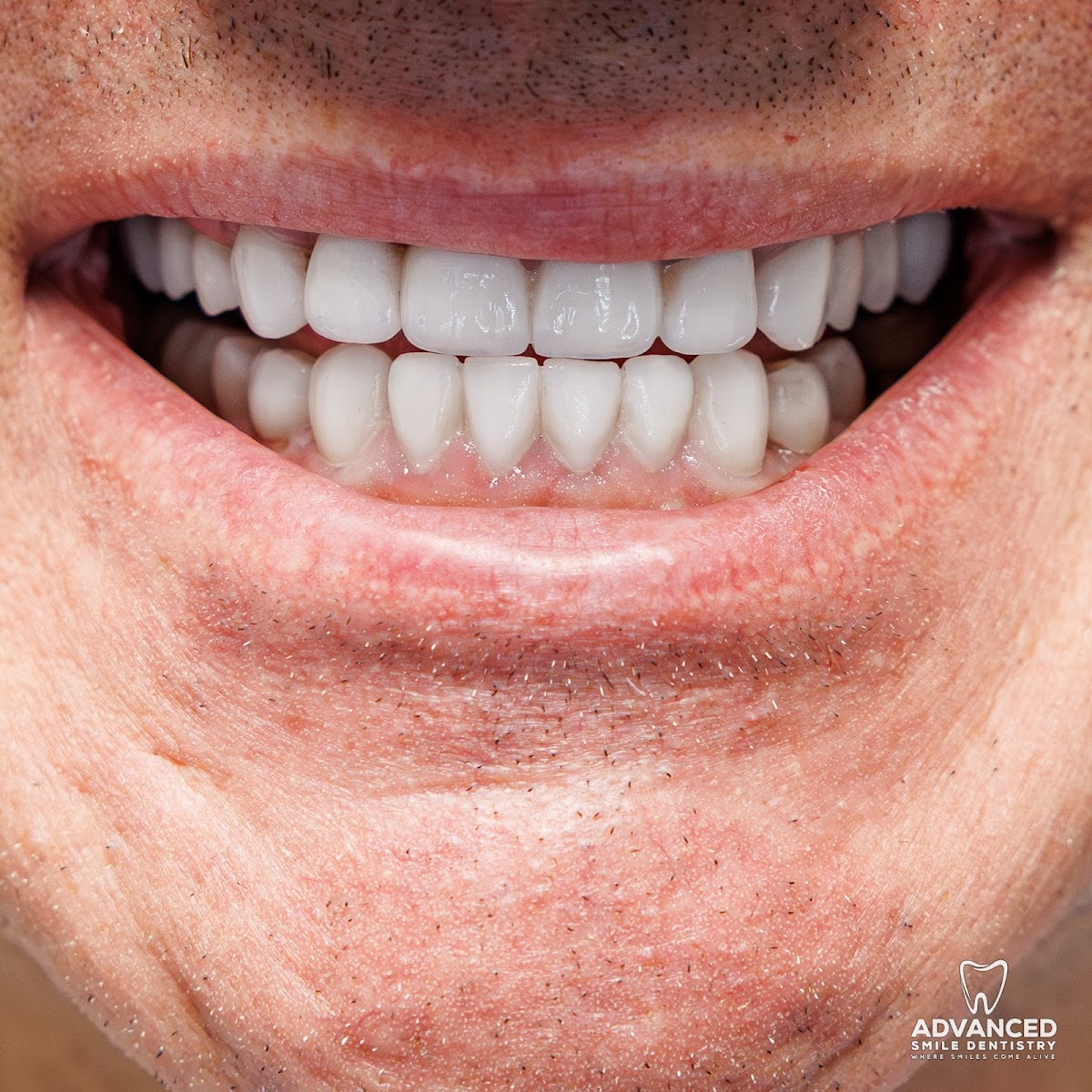 Advanced Smile Dentistry | Dental Implant photo 3