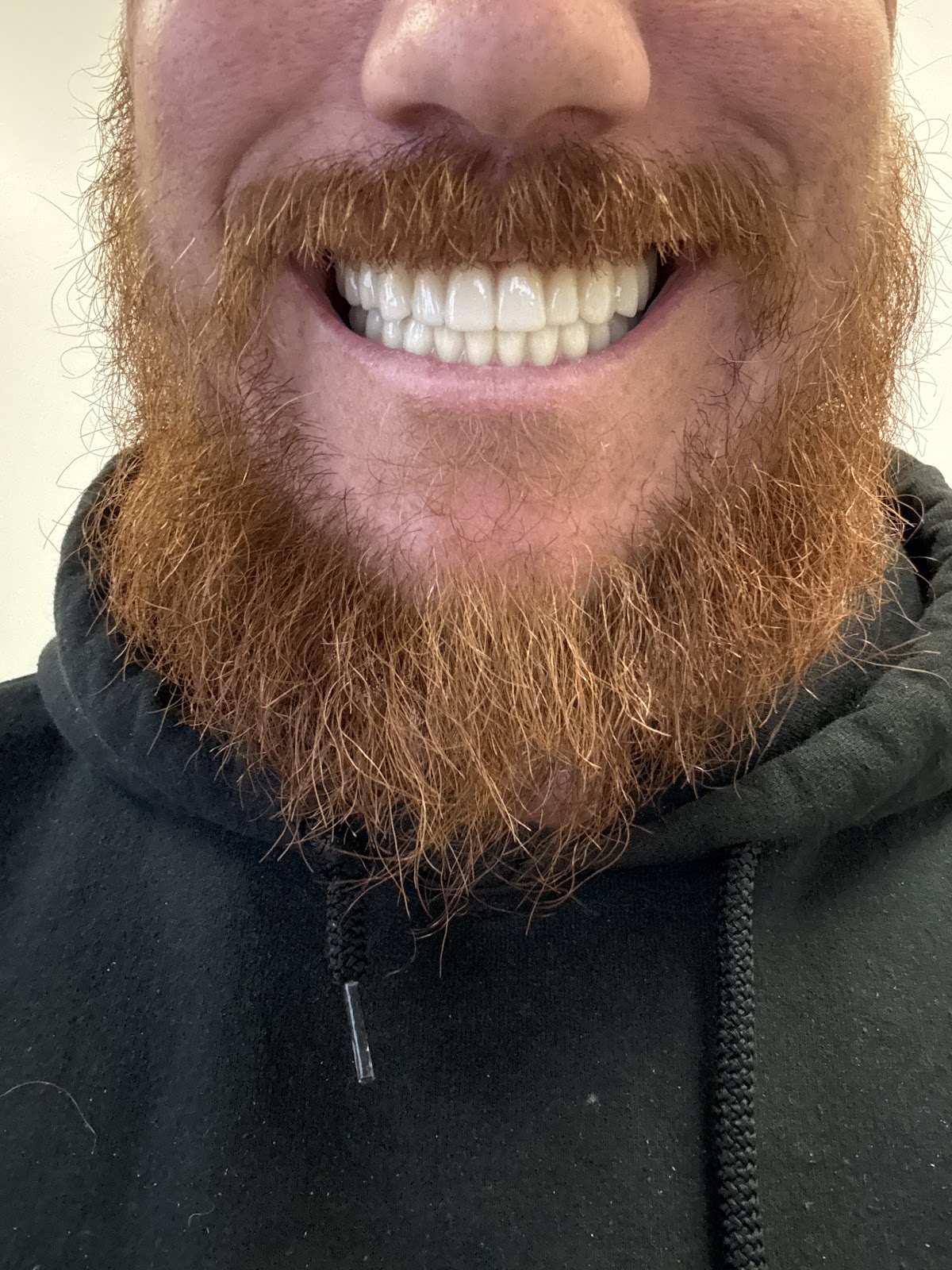 Ora 4x Full Arch Implant Center Roseville photo 5