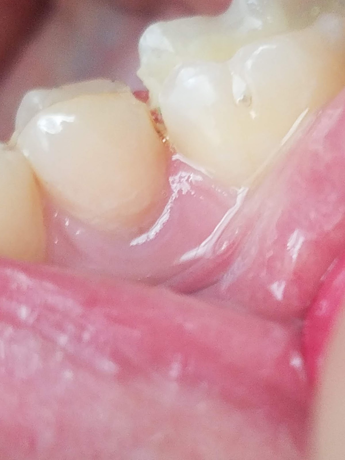 Aspen Dental - Pinellas Park photo 1