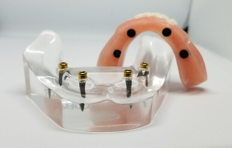Smile Now Portland Dentures and Implants photo 4