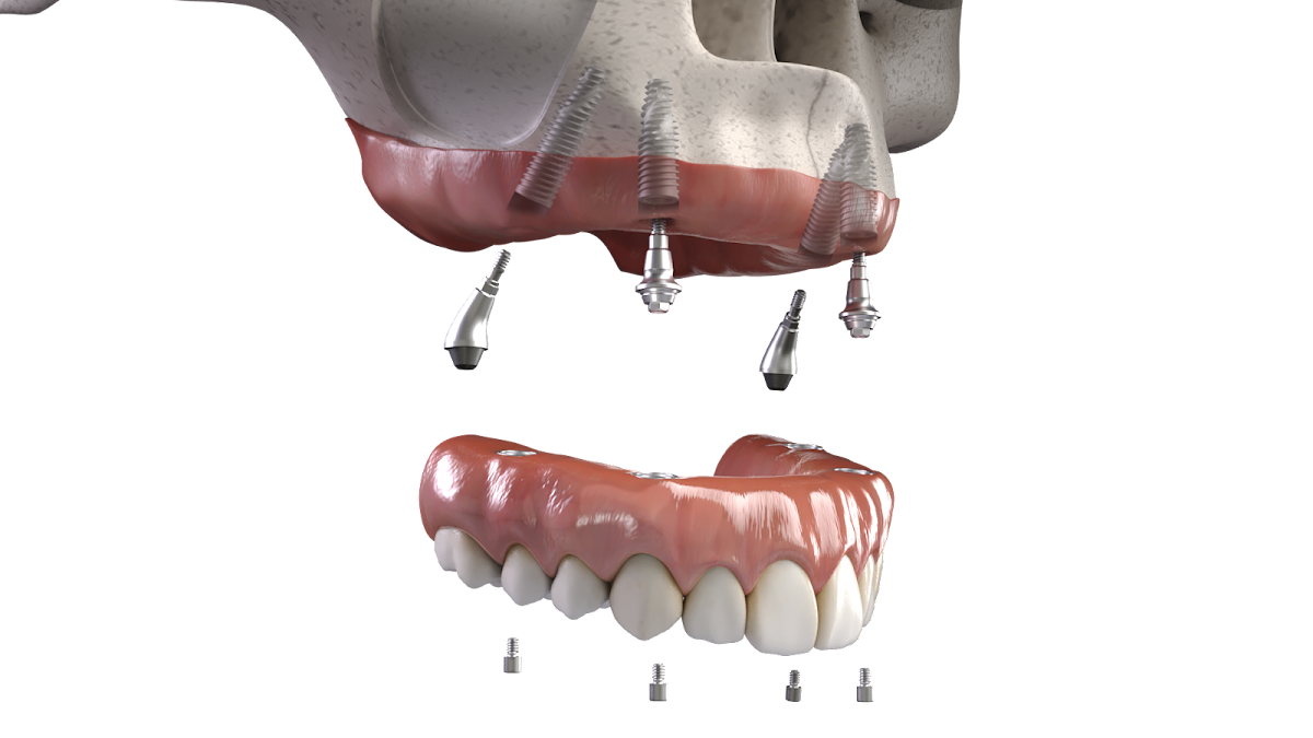 Implant Dental Works photo 4