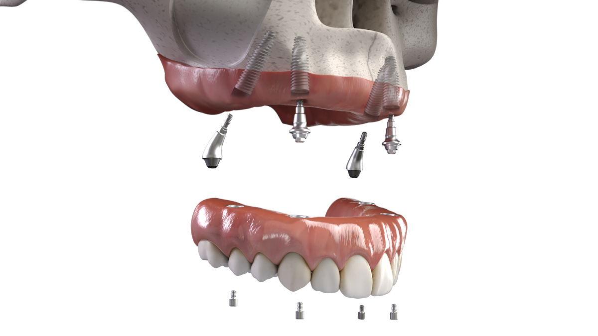 Implant Dental Works photo 6