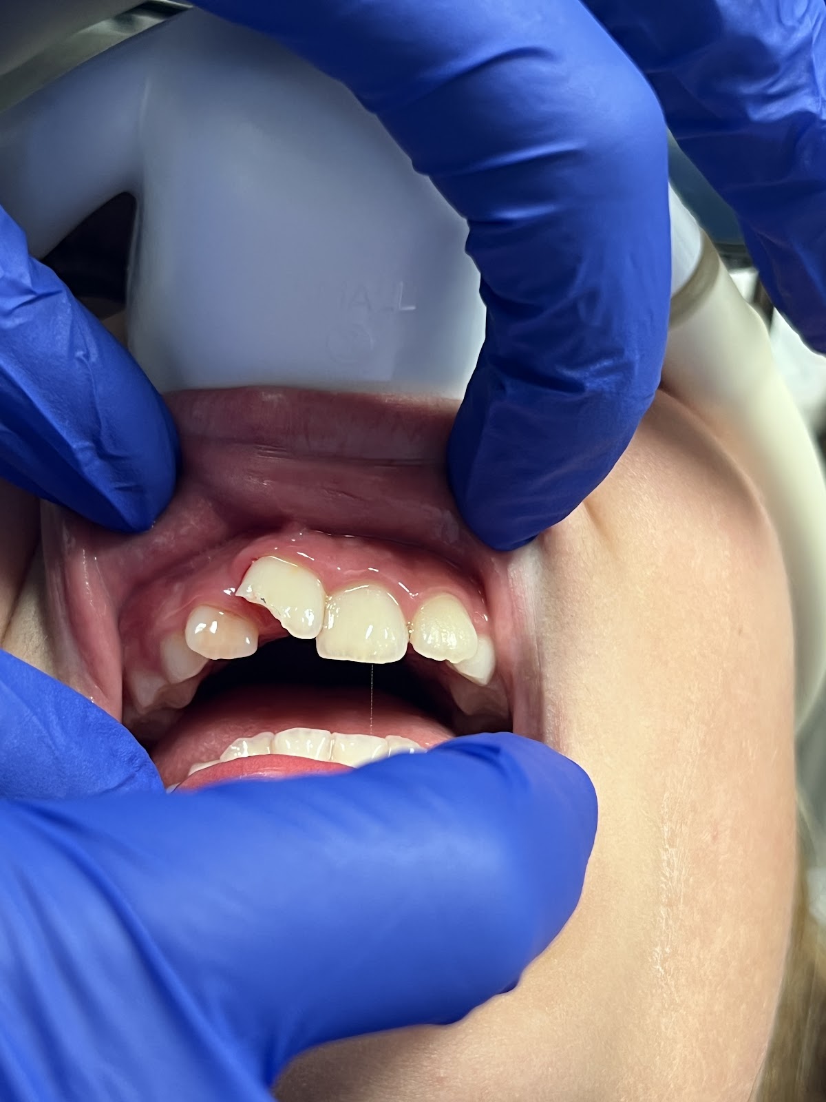 Canyon Dental | Dr. Joe Schmidt | Lewiston and Clarkston photo 1