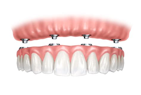 Dental Implants And Prosthodontics photo 4