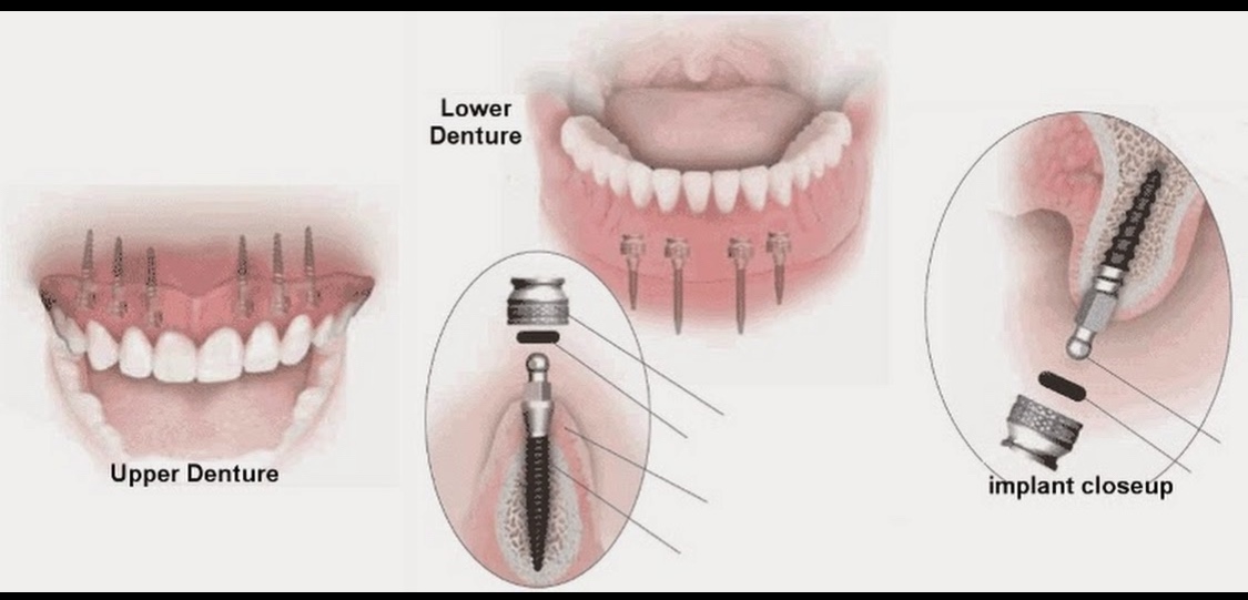 Mini Dental Implant Center photo 6