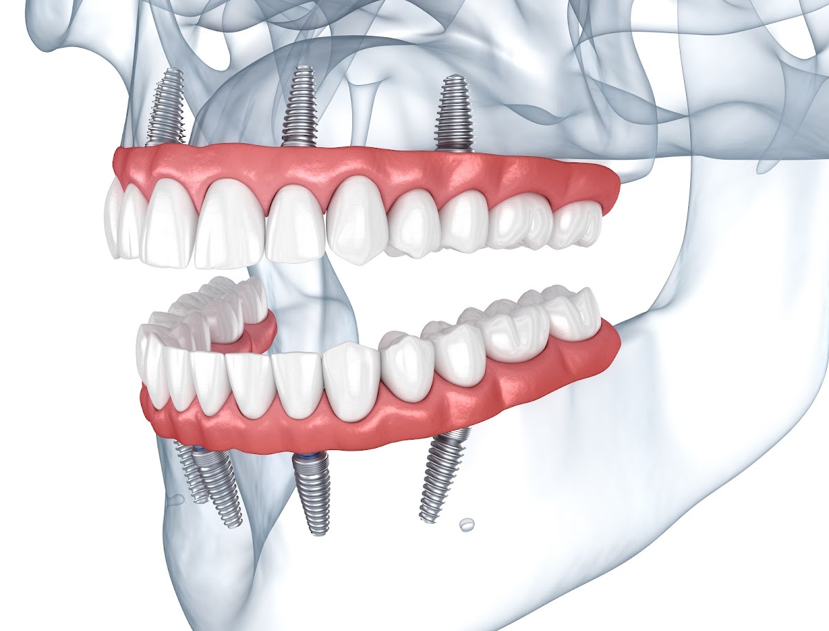 Now Dentures and Implants photo 3