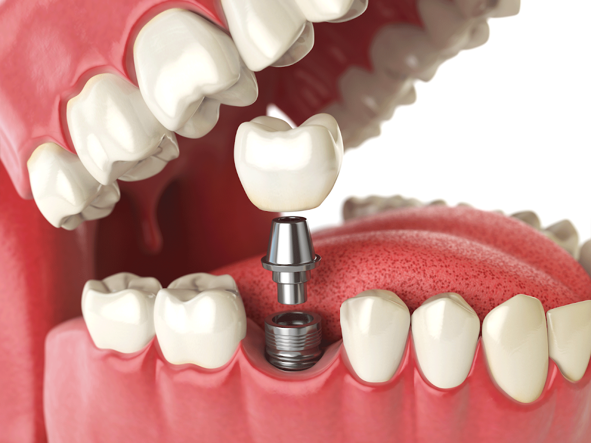 Now Dentures and Implants photo 4