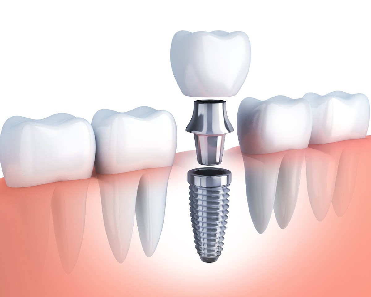 1899 Dental Implant photo 4
