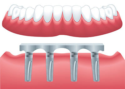 1899 Dental Implant photo 5