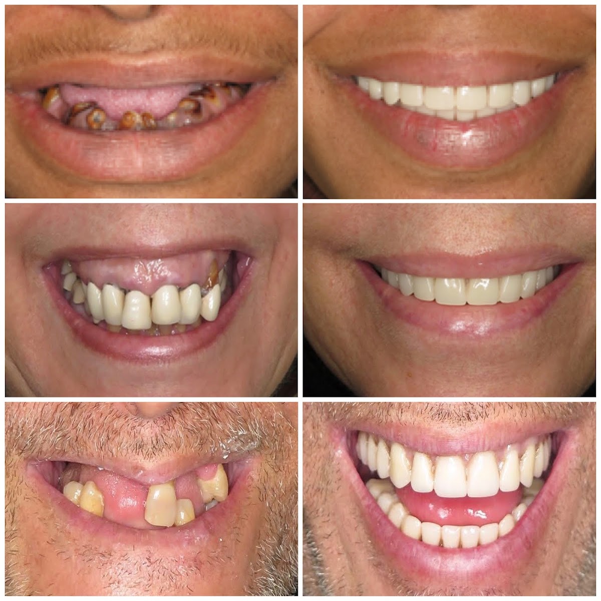 All on Four Dental Implants Long Island photo 2