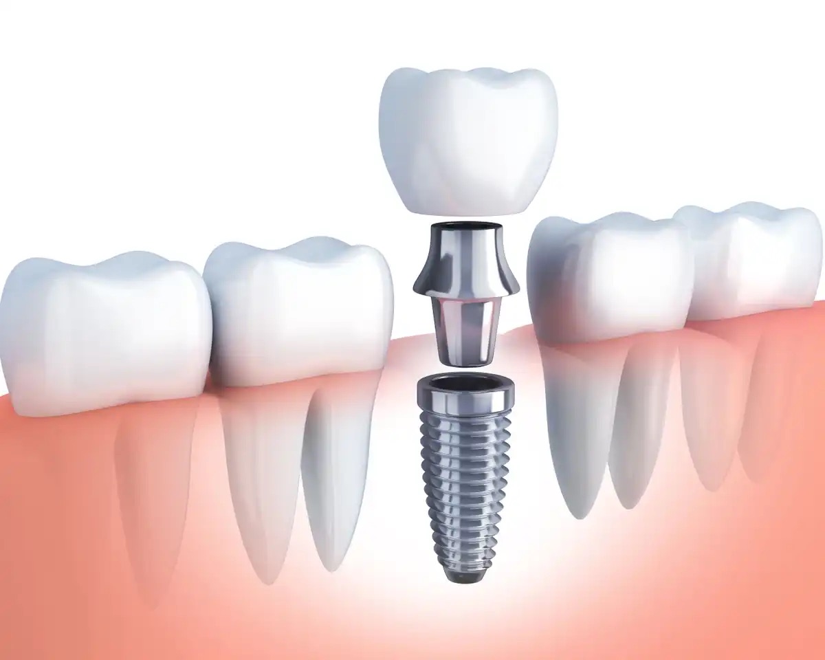 Best Value Dentures and Implants Palmetto Bay photo 3