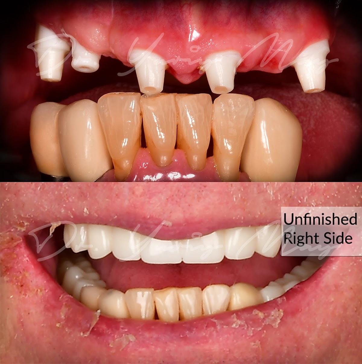 Natural Dentistry | Dr. Yuriy May | Ceramic Implant Dentistry photo 6