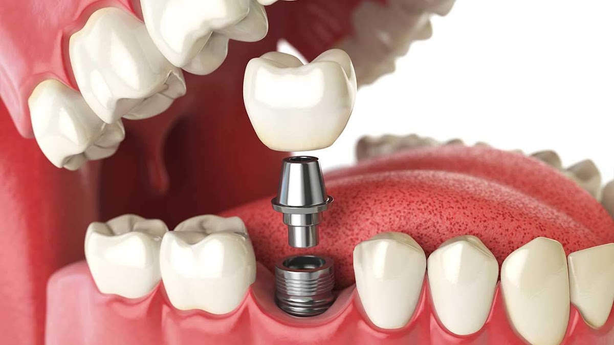 East Louisville Oral Surgery and Dental Implants photo 2