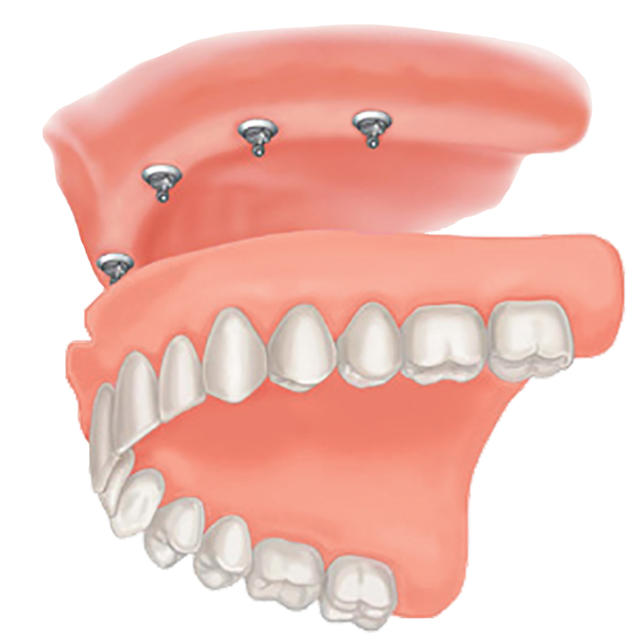 Mini Dental Implant Solutions Gaylord, Mi photo 2
