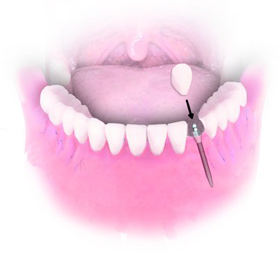 Mini Dental Implant Solutions Gaylord, Mi photo 3