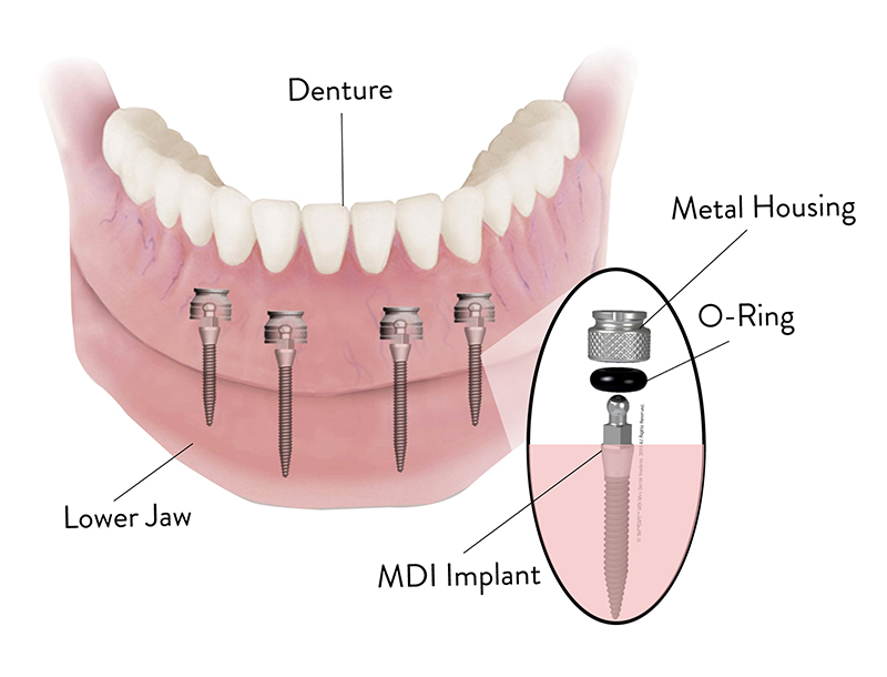 Mini Dental Implant Solutions Gaylord, Mi photo 4