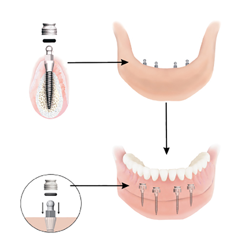 Mini Dental Implant Solutions Gaylord, Mi photo 5