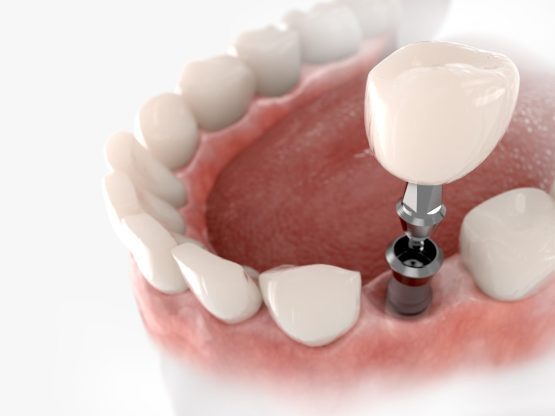 The Dental Implant Place photo 3