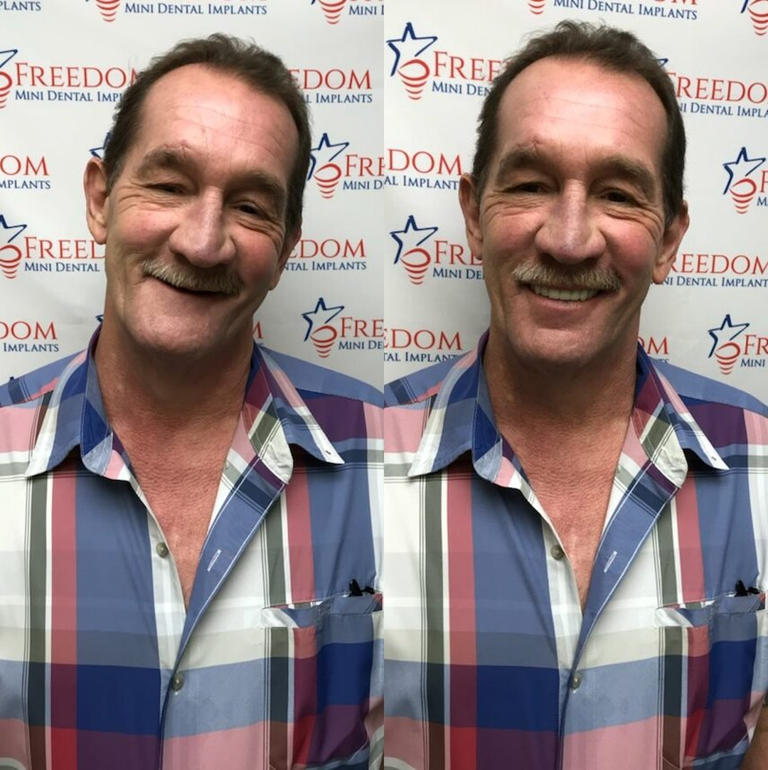 Freedom Mini Dental Implants photo 5