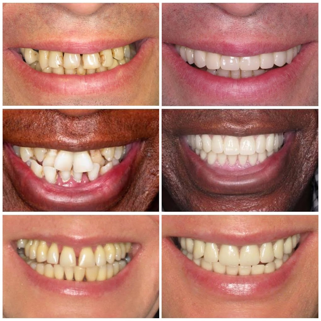 All on 4 Dental Implants Westchester photo 1