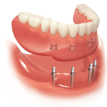 Bay Area Mini Dental Implant Centers Of America photo 6
