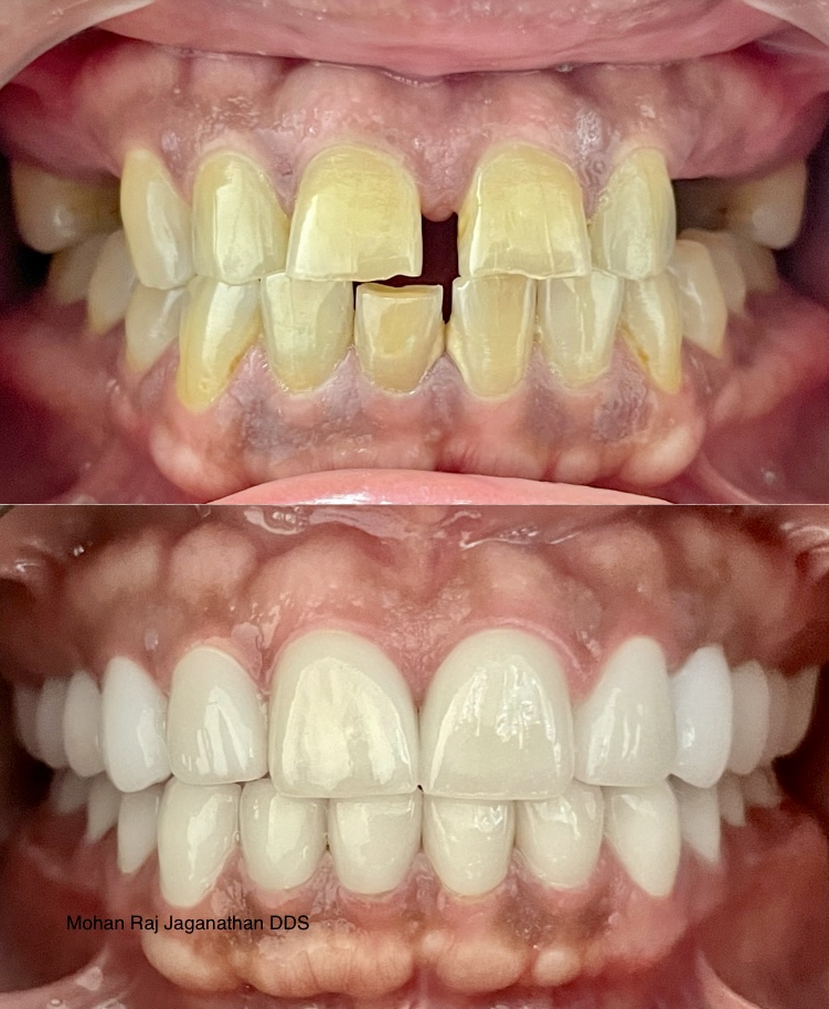 Elite Dental - Mohan Raj Jaganathan Dds & Veena Raja Dds Phd photo 2