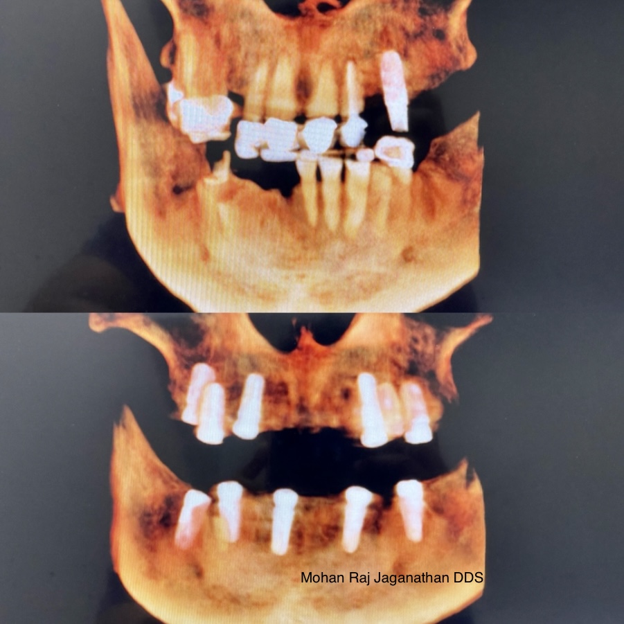 Elite Dental - Mohan Raj Jaganathan Dds & Veena Raja Dds Phd photo 6