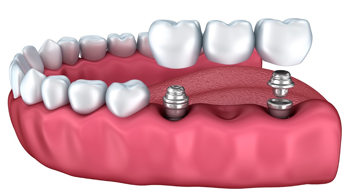 Princeton Oral & Maxillofacial Surgery | Dental Implant Center photo 4